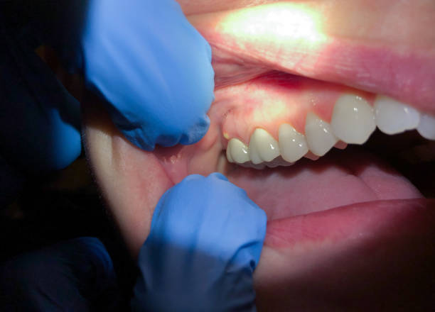 Best Emergency Dentist for Knocked-Out Tooth in Pineland, TX