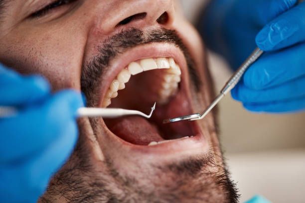Best Emergency Dentist for Lost Fillings or Crowns in Pineland, TX